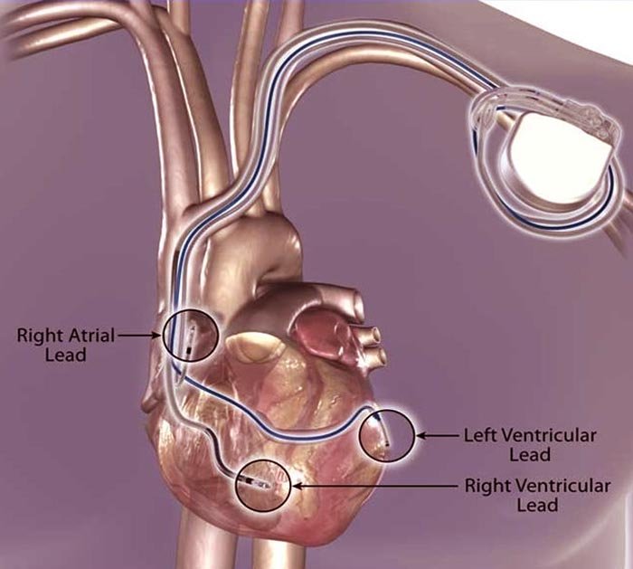 cardiac-resynchronization-therapy
