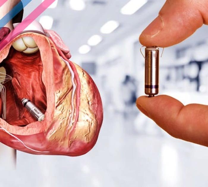 leadless-pacemaker-delhi